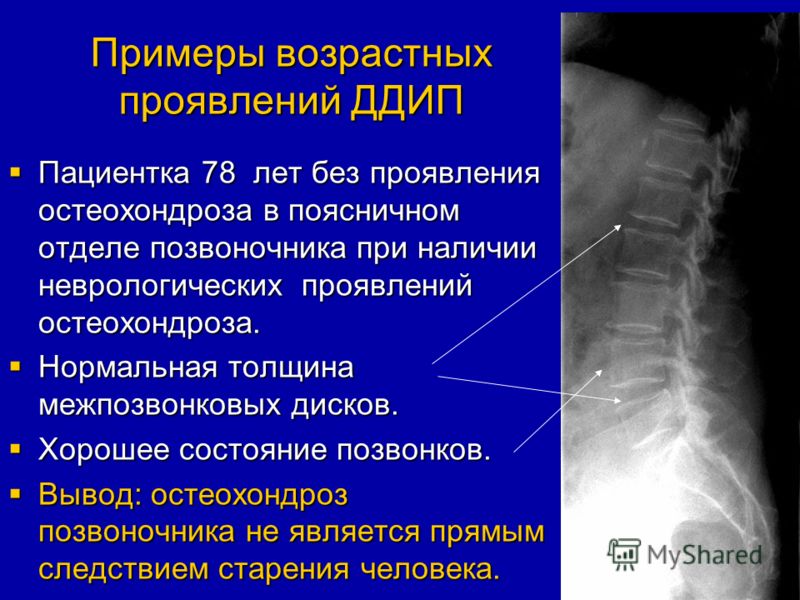 Поясничный остеохондроз начальные проявления Поясничный остеохондроз начальные проявления