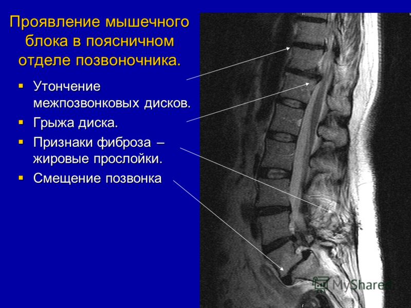 Что будет если сместить позвоночник Что будет если сместить позвоночник