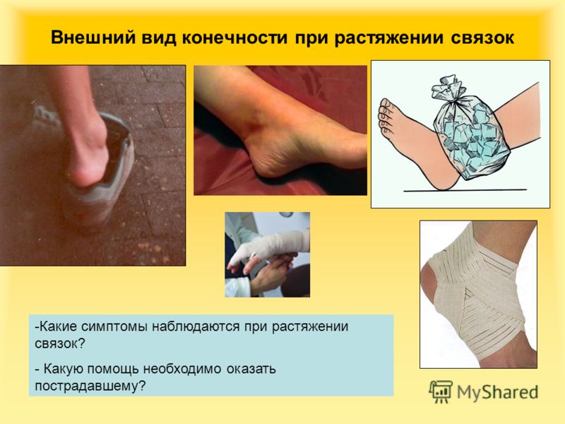 Первая доврачебная помощь при растяжении связок и вывехах суставов чем лечить суставы на пальцах