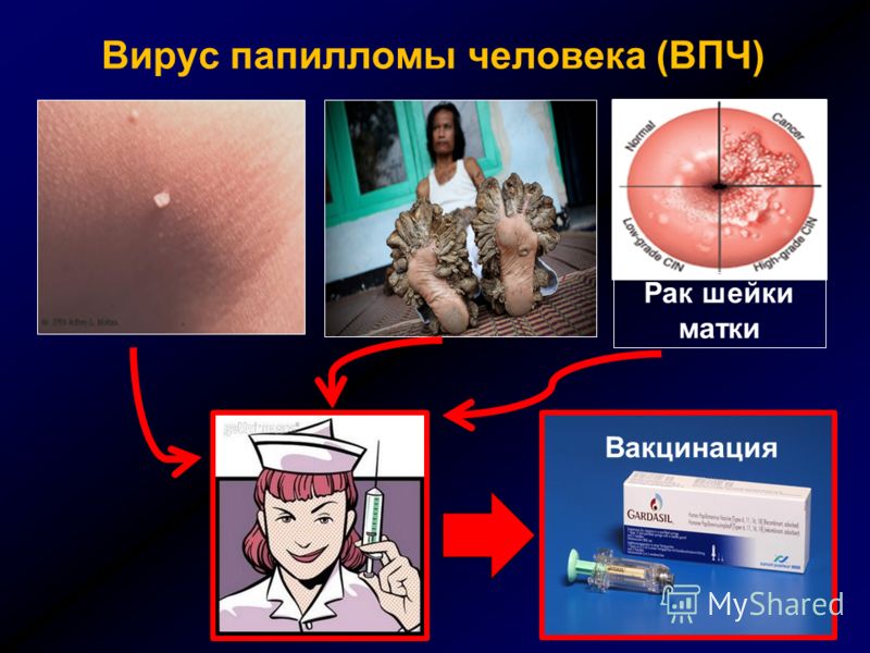konenechno zhenshin cheloveka papillomi lechitsya 45 u virus schitayu chto dopuskaete Вирус папилломы 45 человека у женщин лечится фото