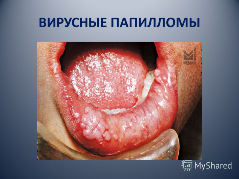 izvinyayus no cheloveka slizistoy papillomi virus foto na spasibo chto eto Вирус папилломы человека на слизистой фото фото