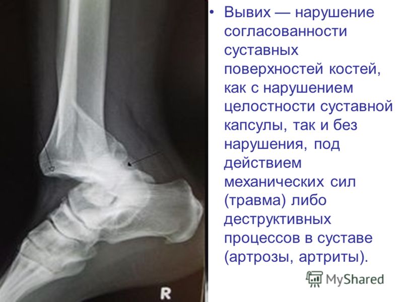 Травматические вывихи суставов презентация фиксатор плечевого сустава фирмы