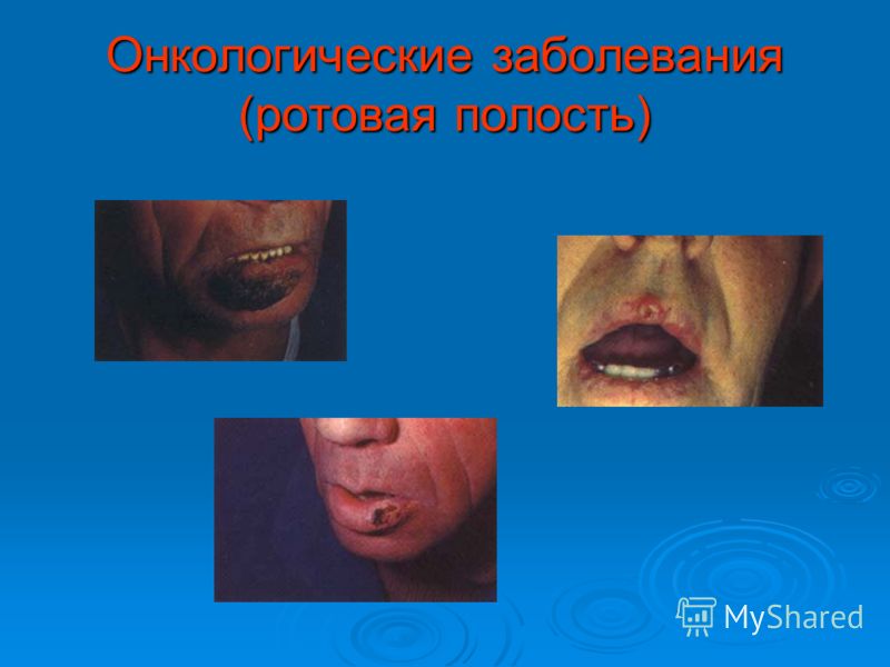 изжога и запах изо рта изжога и запах изо рта