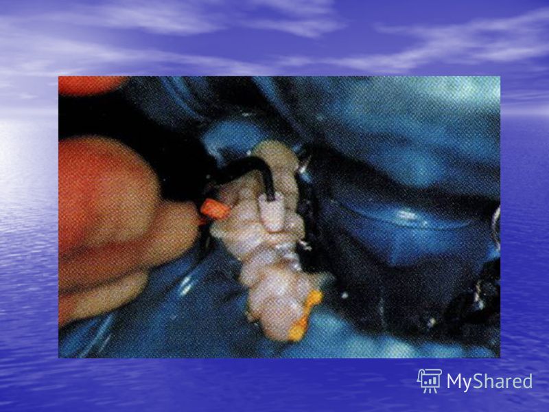 Методика восстановления коронки зуба Методика восстановления коронки зуба