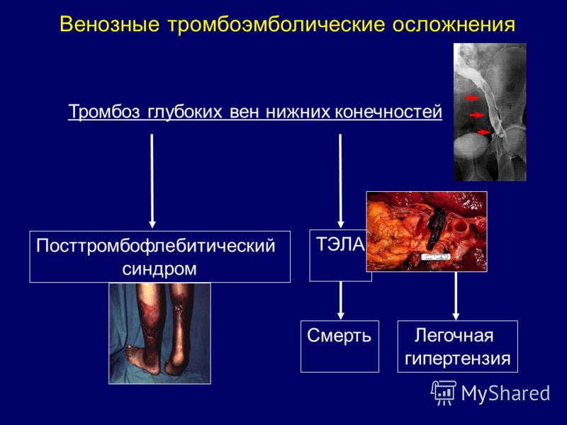Венозные тромбоэмболические осложнения Тромбоз глубоких вен нижних конечностей Посттромбофлебитический синдром ТЭЛА Смерть Легочная гипертензия
