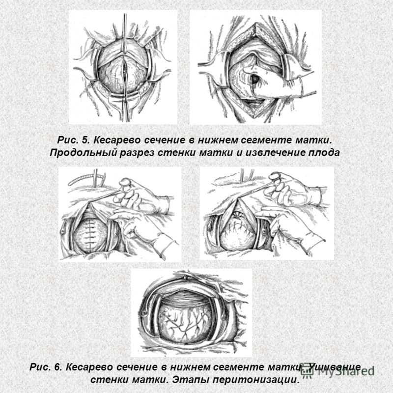 caesarean section Cesarean section has been part of human culture since ancient times and there are tales in both western and non-western cultures of this procedure resulting in live mothers and offspring according to greek mythology apollo removed asclepius, founder of the famous cult of religious medicine, from. caesarean section Cesarean section has been part of human culture since ancient times and there are tales in both western and non-western cultures of this procedure resulting in live mothers and offspring according to greek mythology apollo removed asclepius, founder of the famous cult of religious medicine, from.