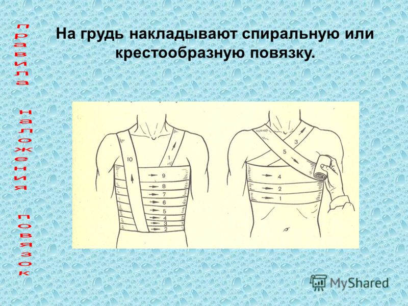 На грудь накладывают спиральную или крестообразную повязку.