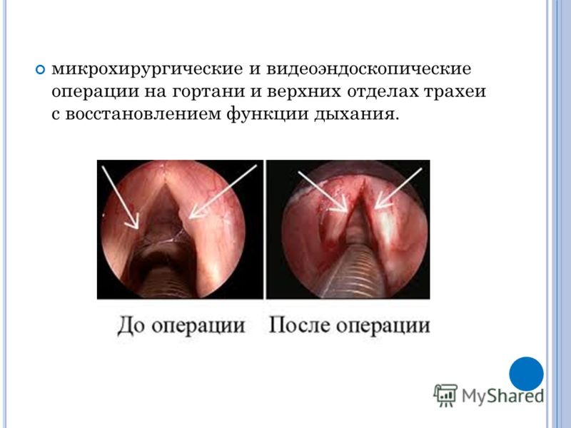 микрохирургические и видеоэндоскопические операции на гортани и верхних отделах трахеи с восстановлением функции дыхания.