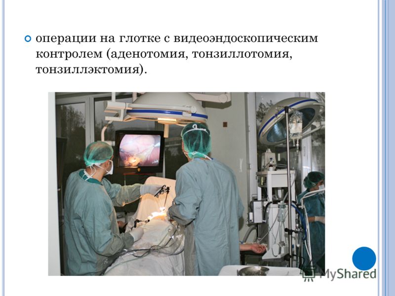 операции на глотке с видеоэндоскопическим контролем (аденотомия, тонзиллотомия, тонзиллэктомия).