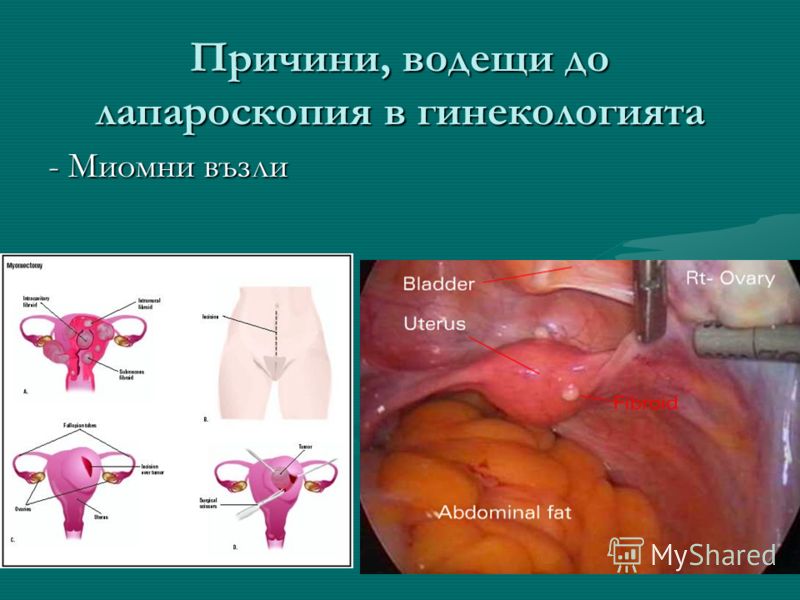 Причини, водещи до лапароскопия в гинекологията - Миомни възли