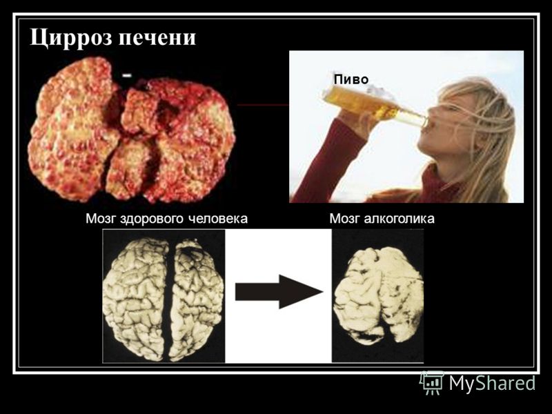 Цирроз печени Пиво Мозг здорового человекаМозг алкоголика