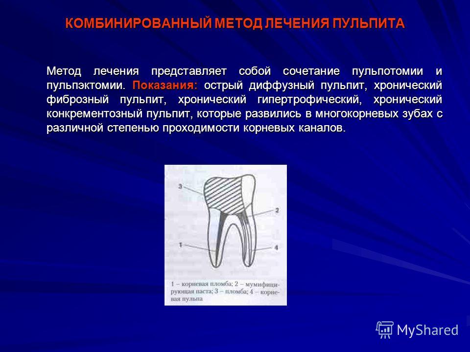 Комбинированный метод лечения зубов Комбинированный метод лечения зубов