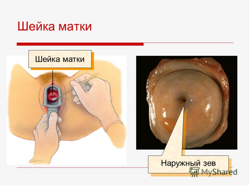 можете шов на шейке матки и приоткрытие внутреннего зева вариант