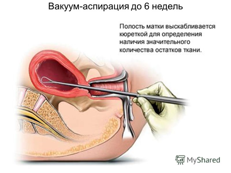 Операция конус в гинекологии