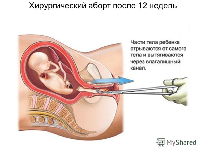 Лишний Вес После Мед Аборта