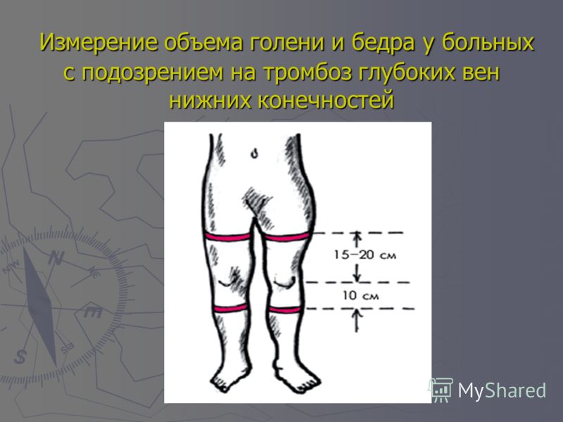 Осложнения после склеротерапии вен как лечить