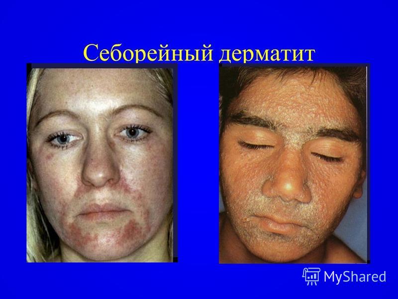 Себорея кожи лица лечение себореи лица Себорея кожи лица лечение себореи лица