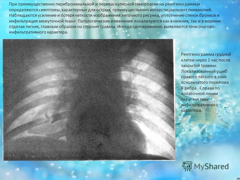 Усилен прикорневой рисунок легких Усилен прикорневой рисунок легких