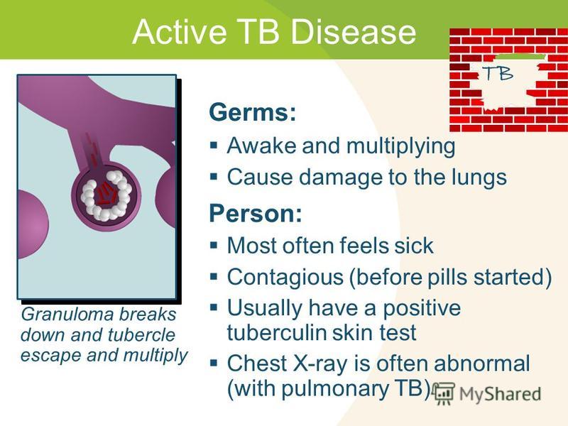 Active tuberculosis contagious