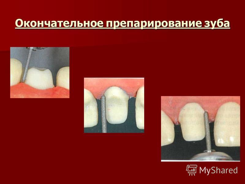 Требование к препарированию зубов Требование к препарированию зубов