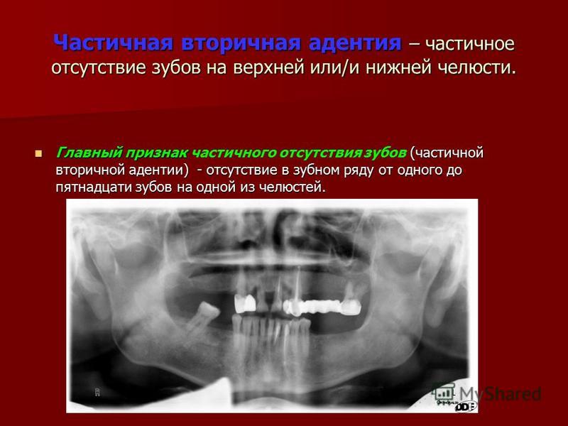 Какие зубы больнее лечить верхние или нижние Какие зубы больнее лечить верхние или нижние