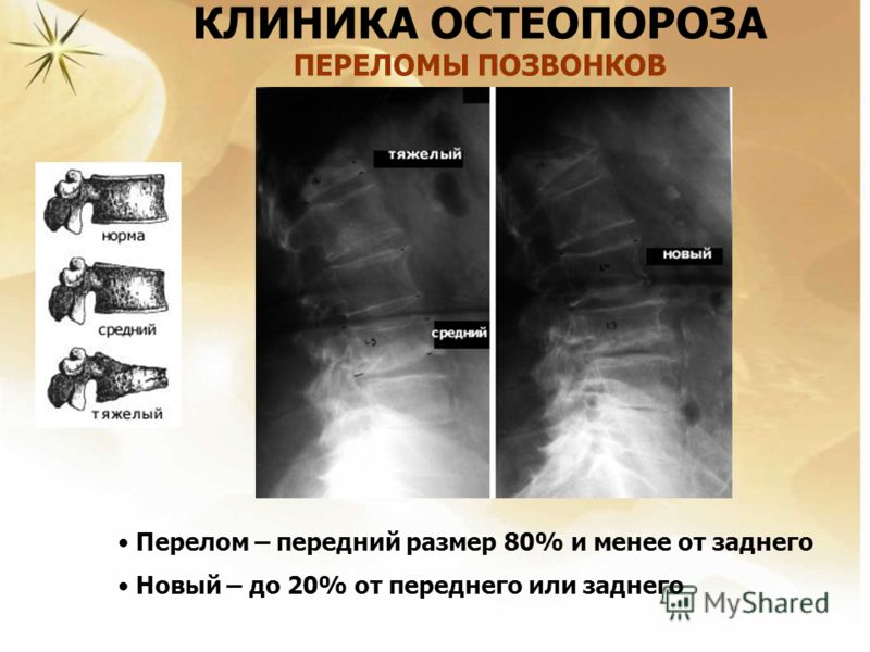 Лечение перелома шейки бедра у пожилых людей в домашних условиях Лечение перелома шейки бедра у пожилых людей в домашних условиях