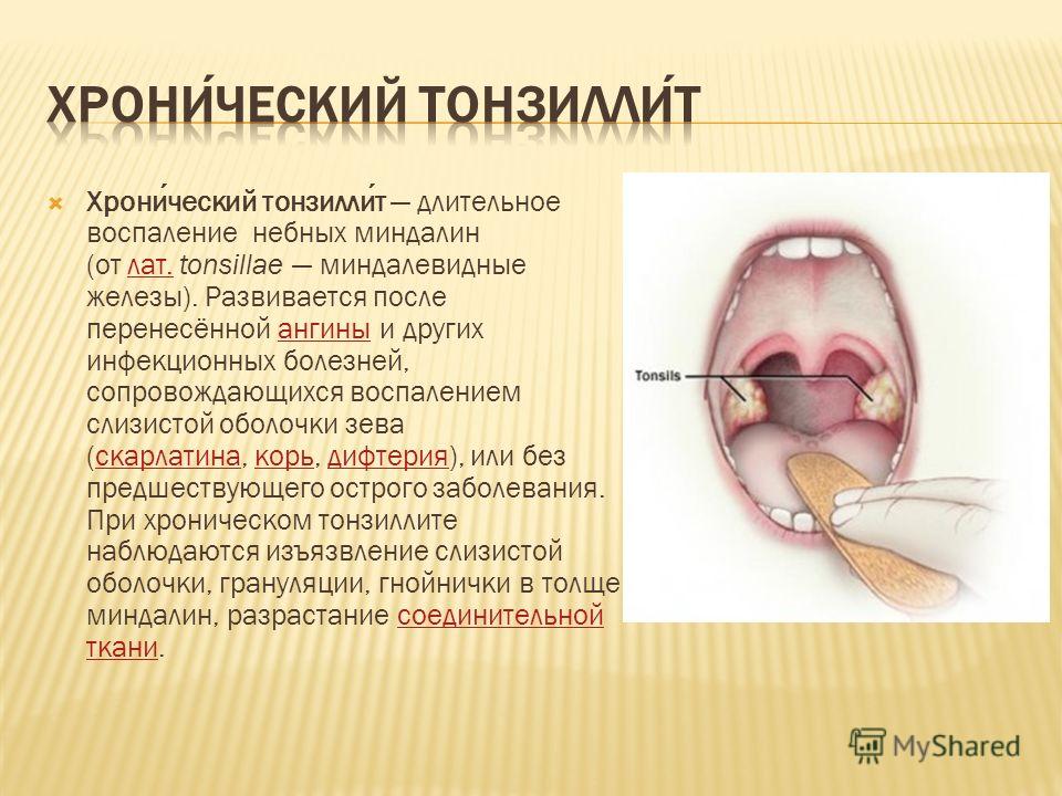 хронический тонзиллит запах изо рта форум хронический тонзиллит запах изо рта форум