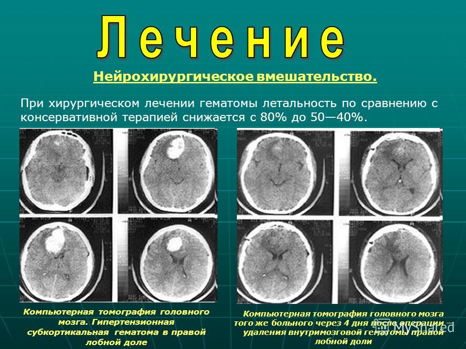 лечение магнитотерапией межпозвонковой грыжи лечение магнитотерапией межпозвонковой грыжи