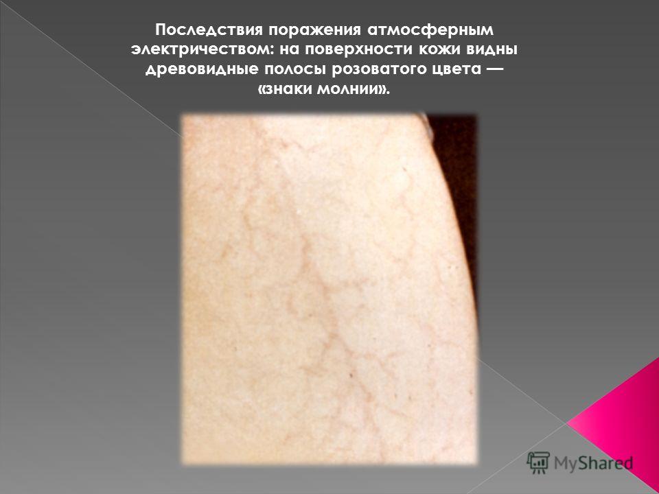 Очаги на коже головы Очаги на коже головы