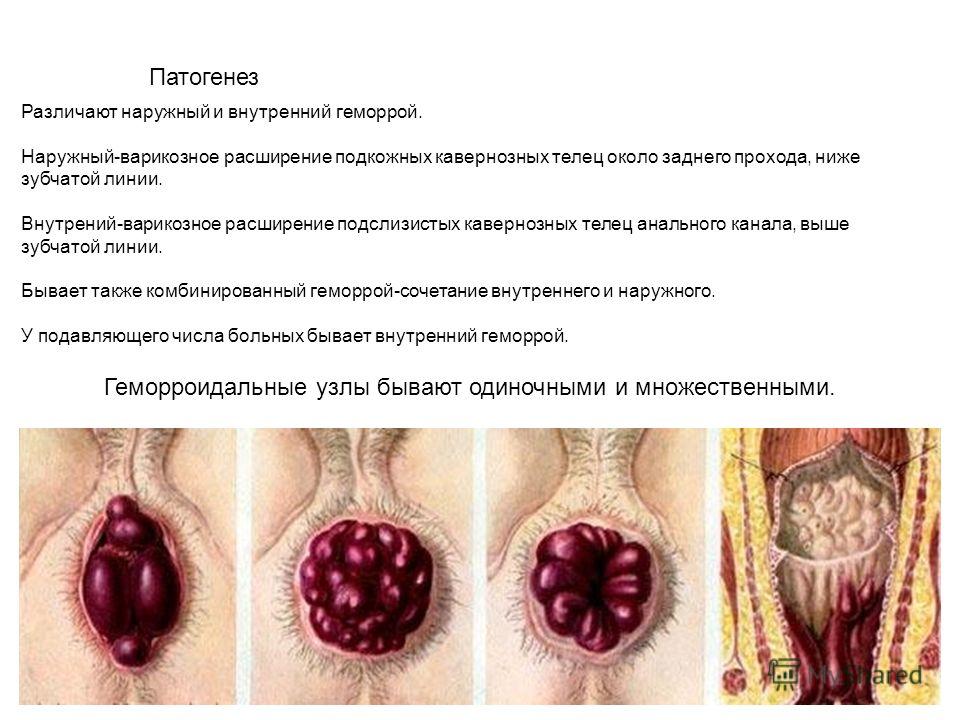 Как вылечить кровоточащий геморрой Все способы лечения