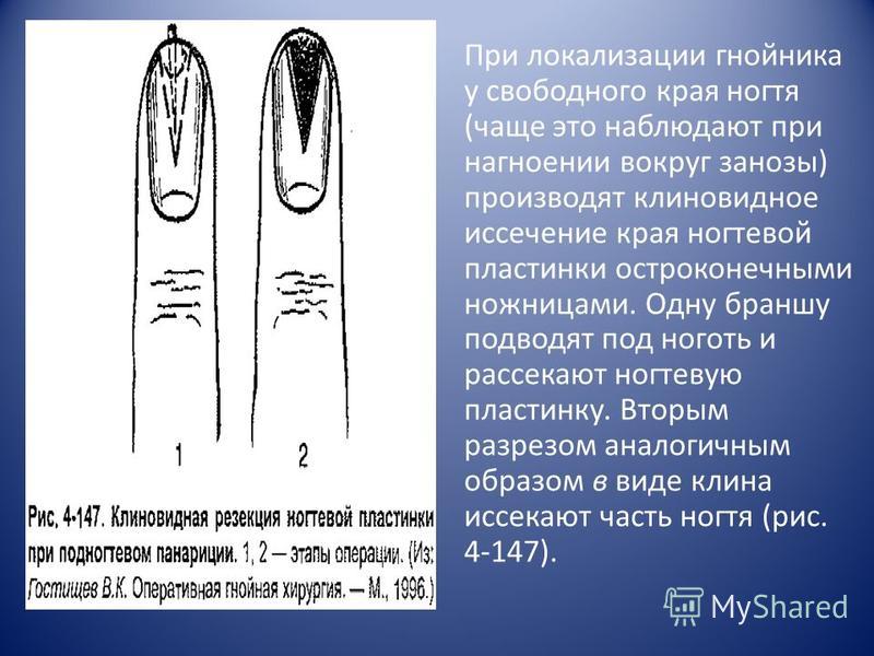 Что делать если палец нарывает под ногтём Что делать если палец нарывает под ногтём