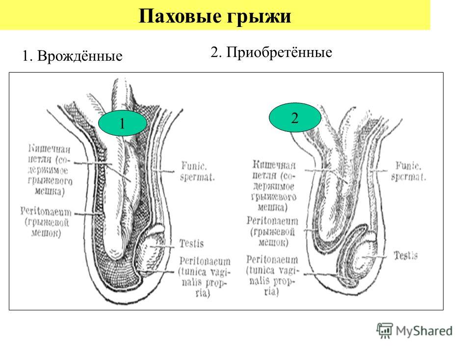 грыжа сбоку Грыжа межпозвоночного диска. Что это такое и как с ней.