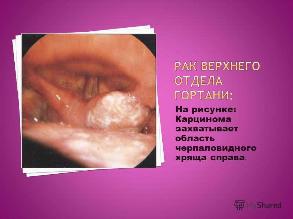 На рисунке: Карцинома захватывает область черпаловидного хряща справа.