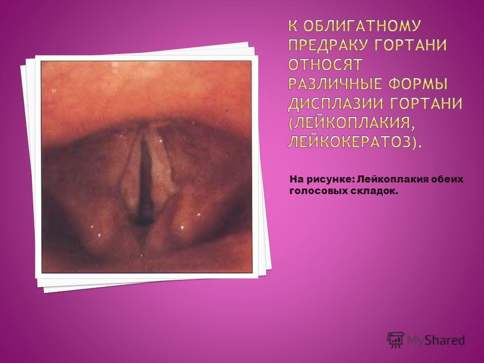 На рисунке: Лейкоплакия обеих голосовых складок.