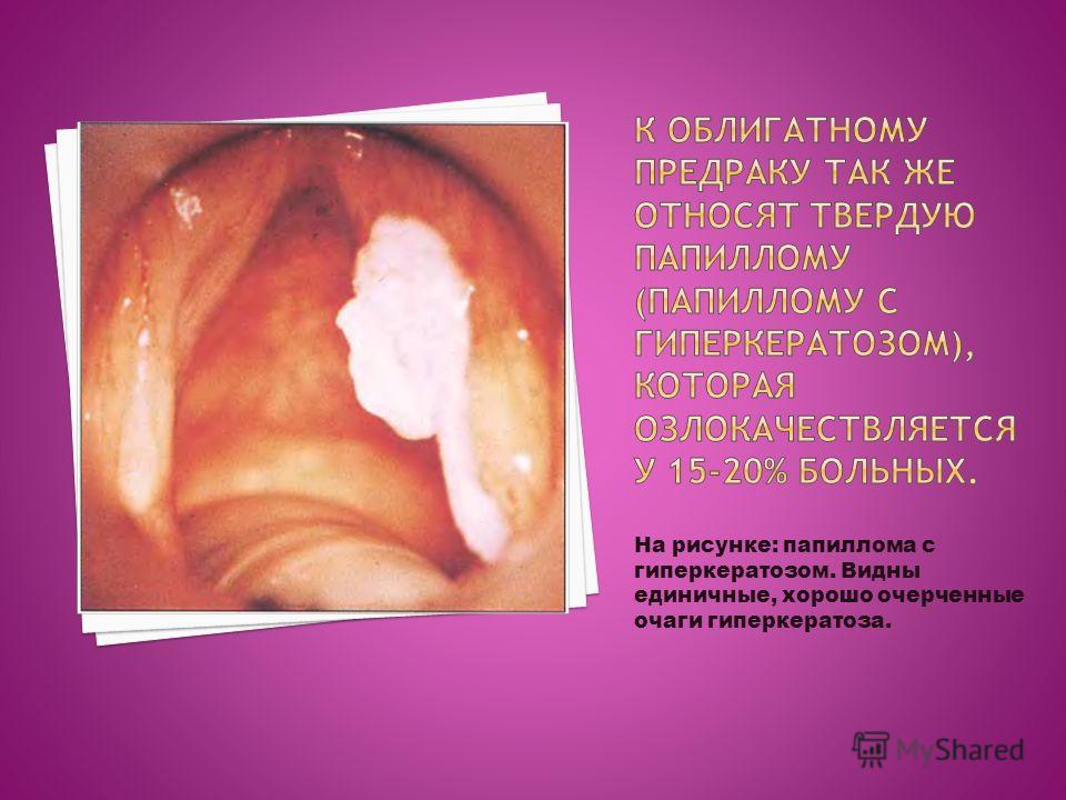 На рисунке: папиллома с гиперкератозом. Видны единичные, хорошо очерченные очаги гиперкератоза.