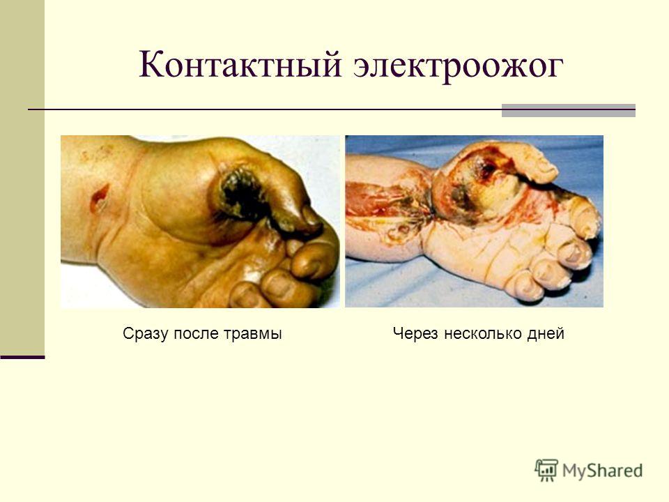 Симптомы некроза на коже Симптомы некроза на коже