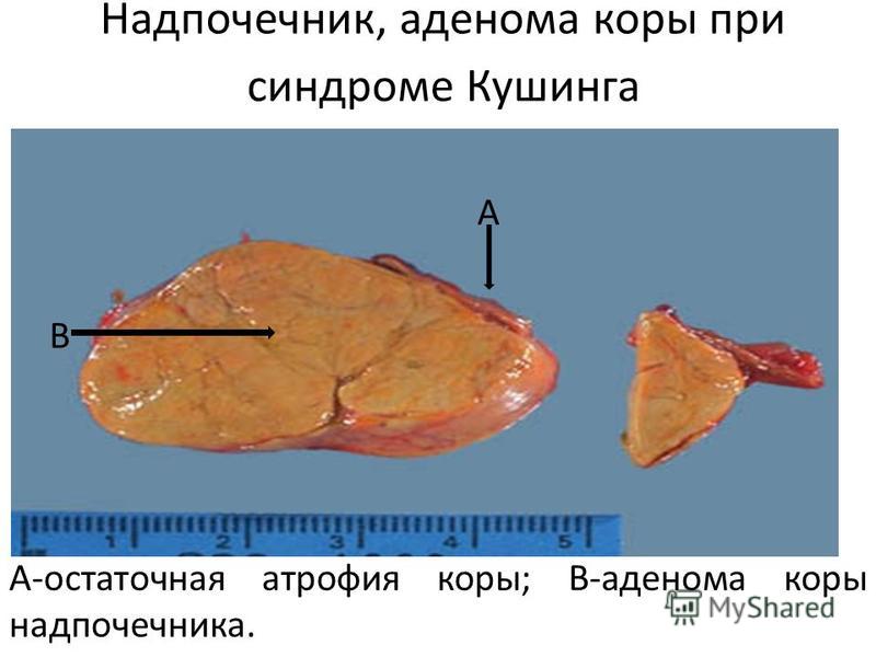 Что такое аденома коры надпочечников Что такое аденома коры надпочечников