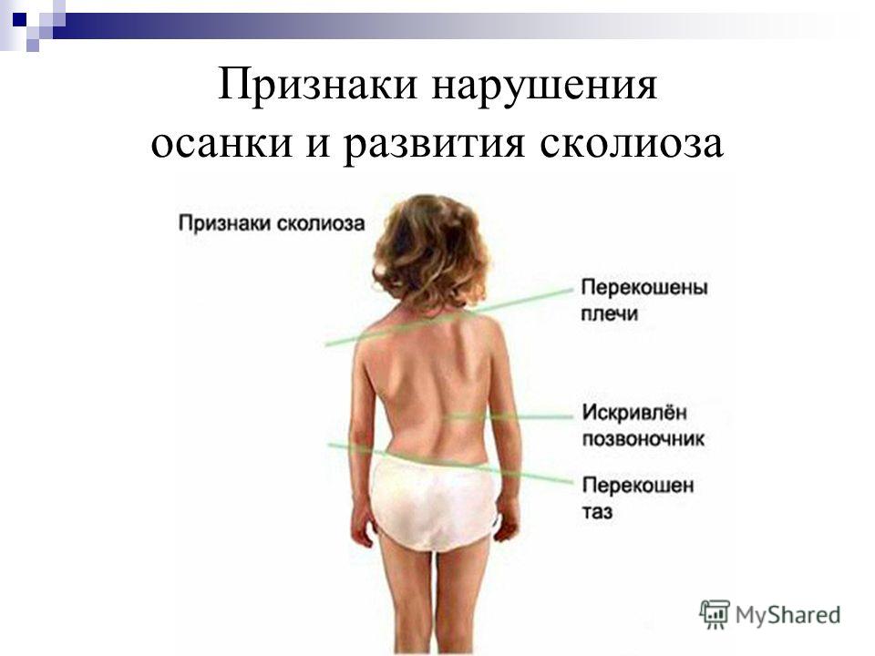 Можно ли в пожилом возрасте исправить сутулость у