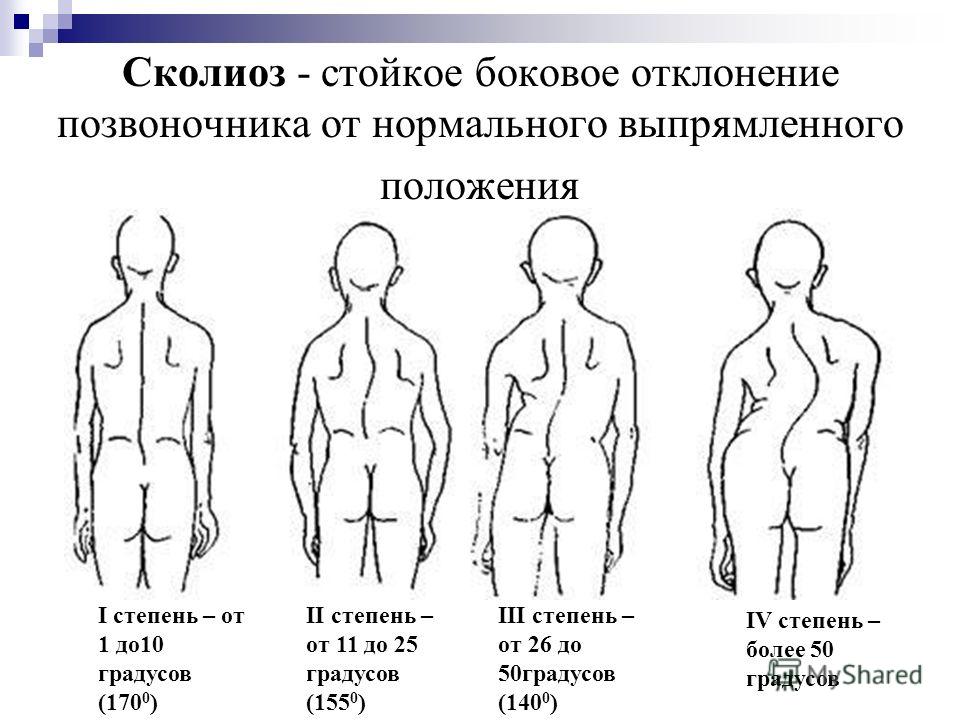 о доклад скалеозе