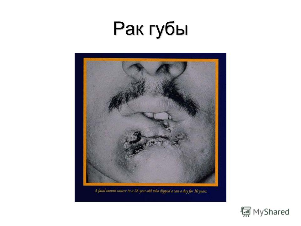 Рак губы