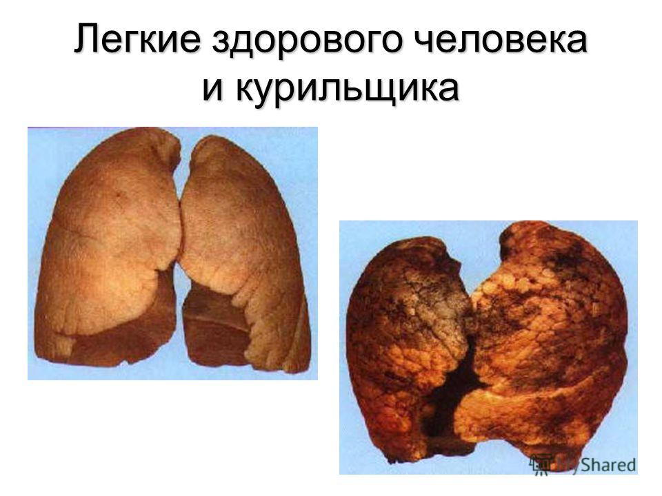 Легкие здорового человека и курильщика