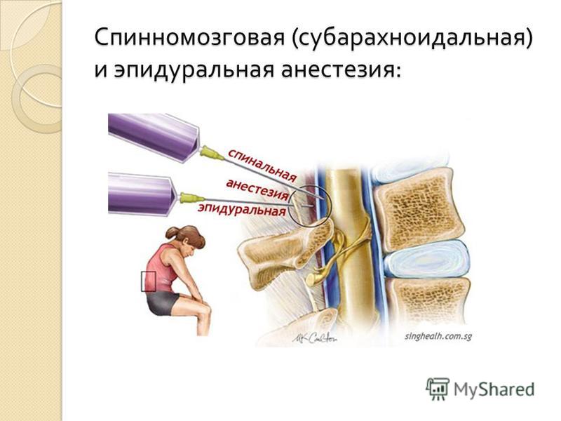 что лучше пои кс спинальная или эптдуральная анастезия Алексей Казаков