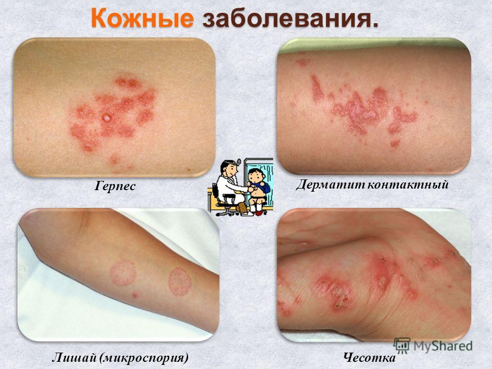 Дерматит кожа рук в руки Дерматит кожа рук в руки