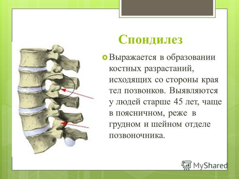 Лфк для спондилез поясничного отдела позвоночника Лфк для спондилез поясничного отдела позвоночника