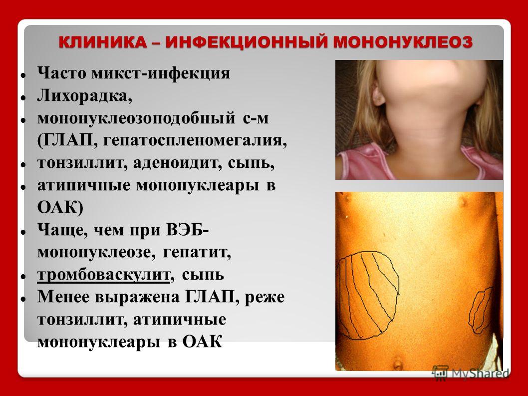 Храп причины возникновения диагностика и лечение