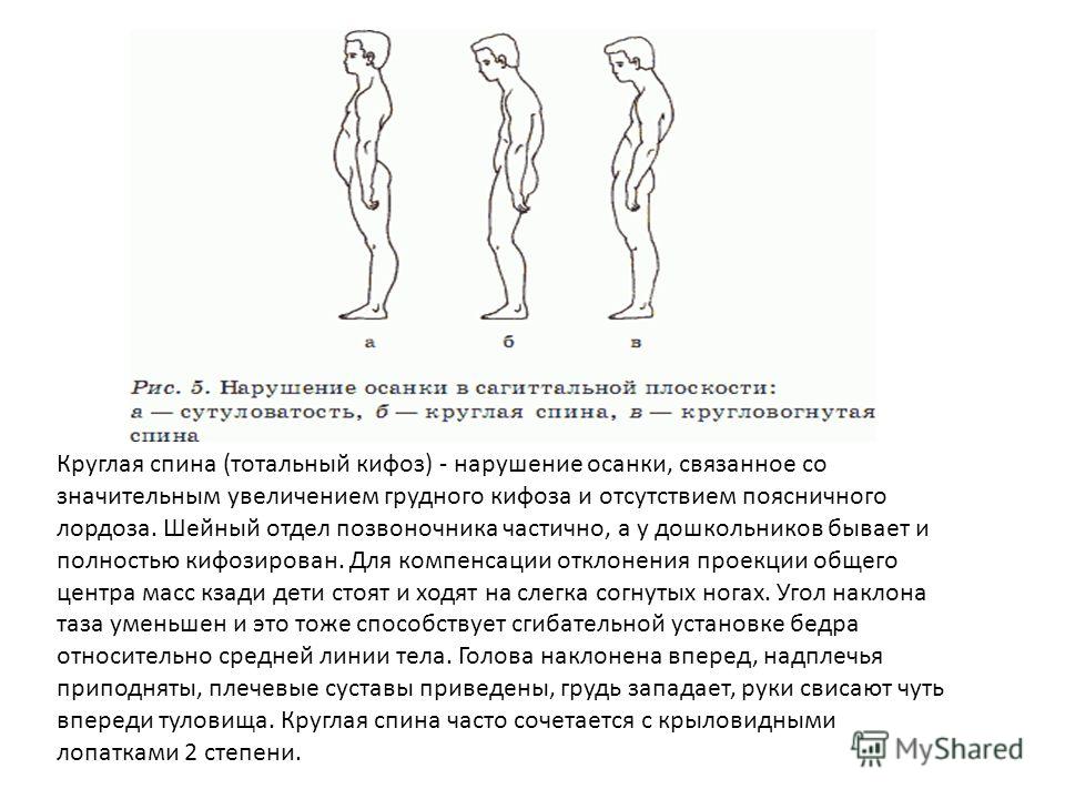 Сколиоз лечение корсет на спину