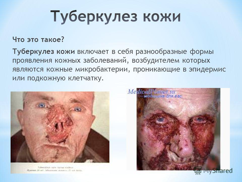 лечение простейших паразитов лечение простейших паразитов