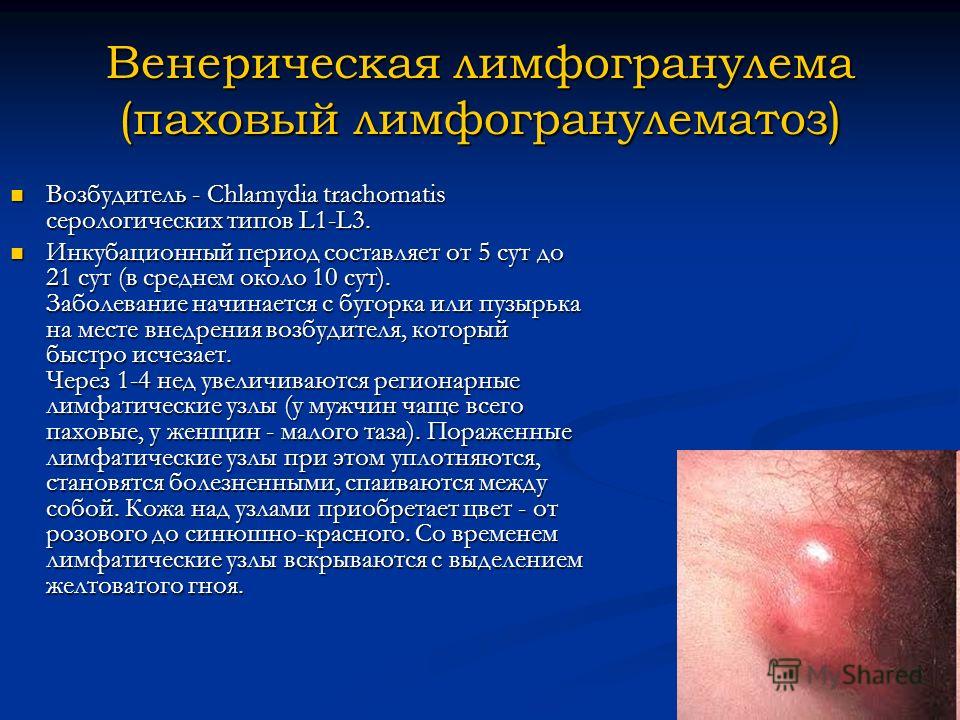 Доклад: Венерическая лимфогранулема