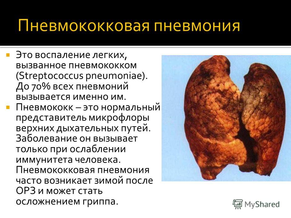 Кашель с болью в грудной клетке и спине Кашель с болью в грудной клетке и спине