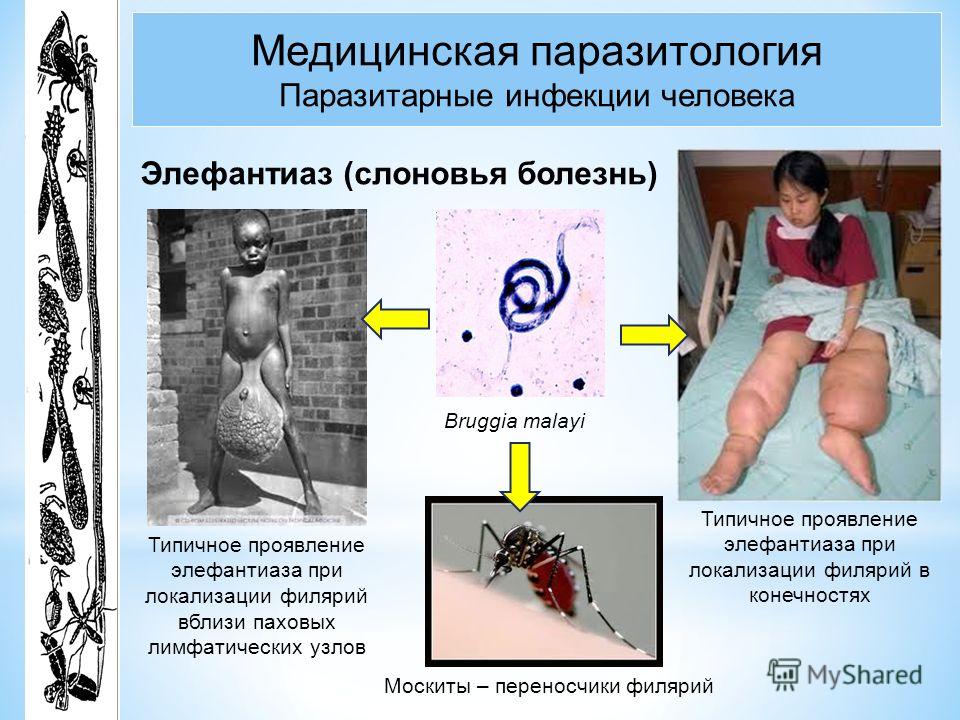 Болезнь пневмония легких как лечить